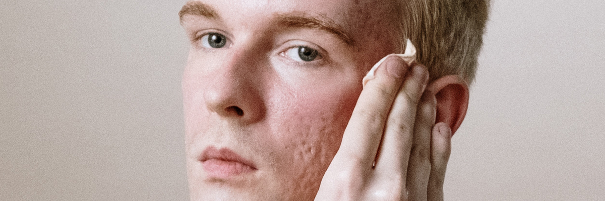 Acne Scarring