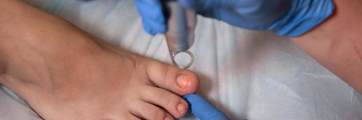 Fungal nails