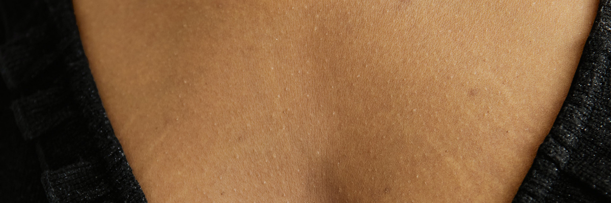 Stretch Marks