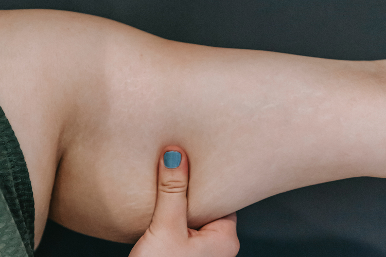 Cellulite Reduction Body Shaping