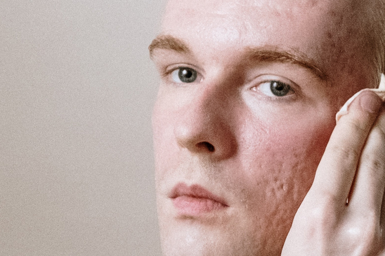 Acne Scarring
