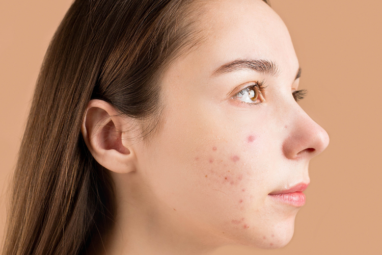 Acne