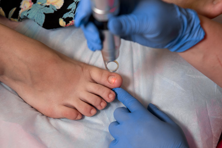 Fungal Nails