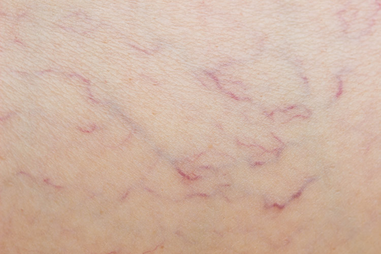Leg Thread Vein Removal