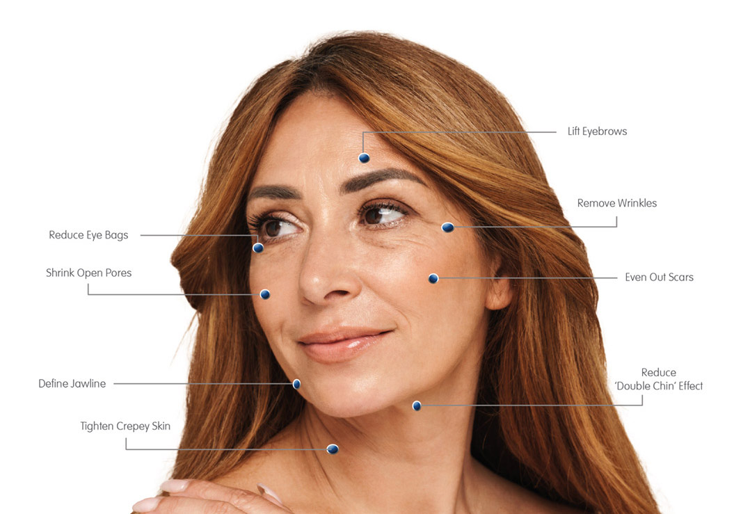 Microneedling and Radio Frequency