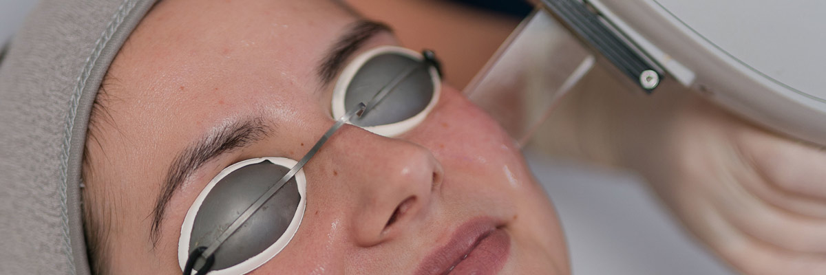 Facial Red Vein Removal