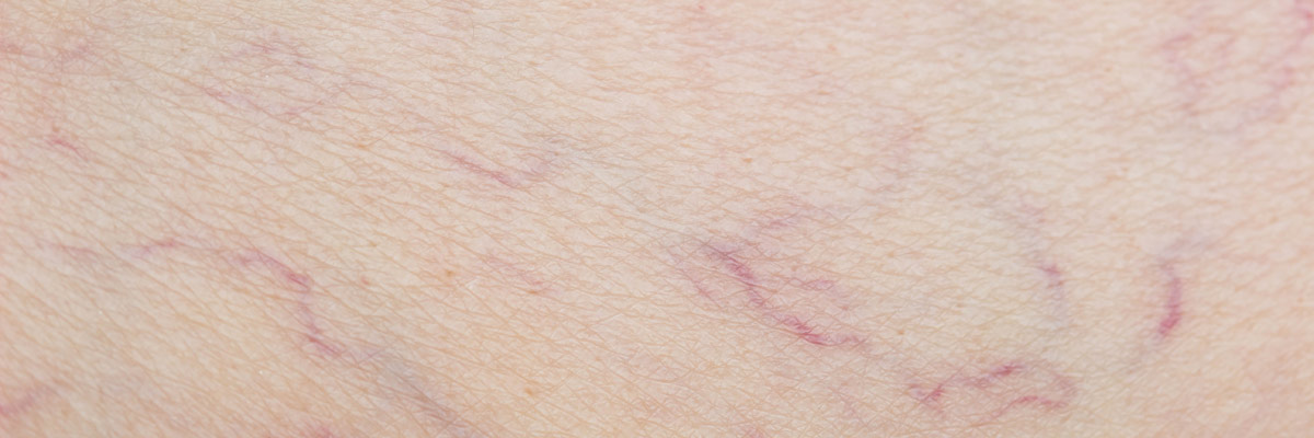 Leg Thread Vein Removal