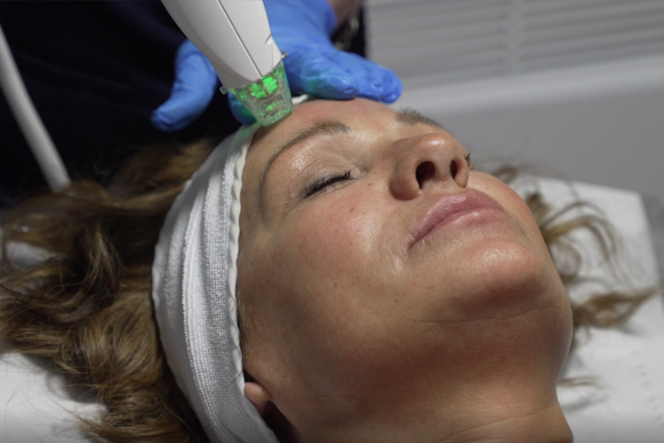 Radiofrequency Microneedling