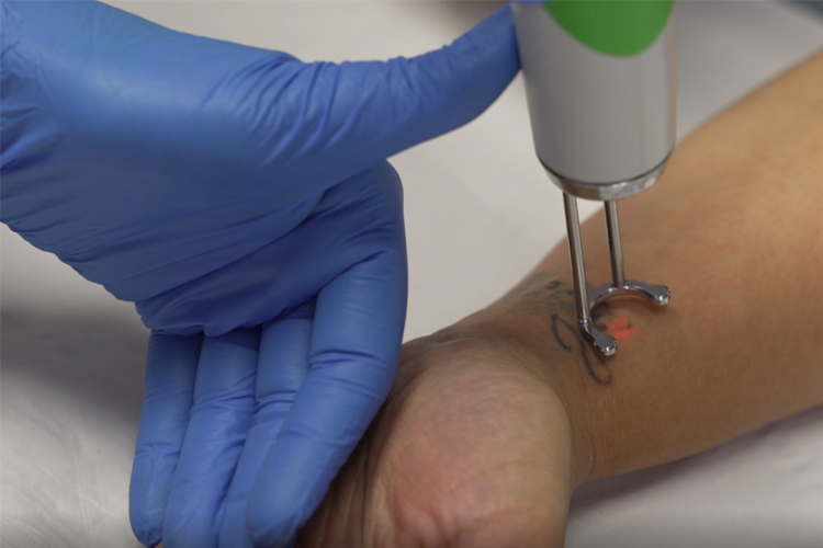 Tattoo Removal Q plus C