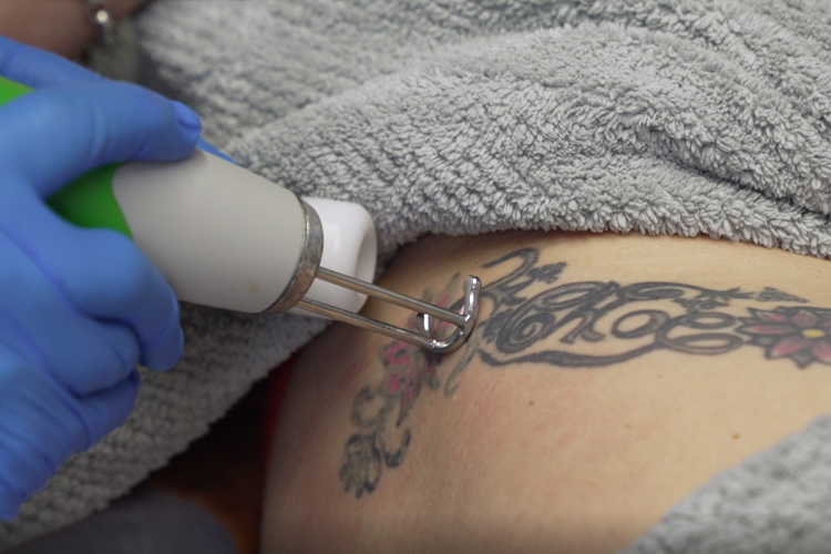 Tattoo Removal Q plus C